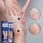 Crème Traitement Varices et Veines Araignées, Soulagement Rapide Gonflement et Douleur, Amélioration Circulation Sanguine, Soin Jambes Lourdes et Fatiguées, Format 20g