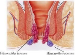 hemorroides 300x220 hemorroides 300x220
